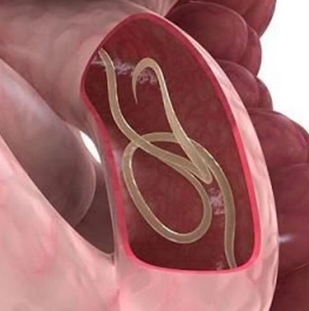 Signos de gusanos en una persona en el tracto gastrointestinal